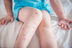 Bed Bug Bites on Small Child